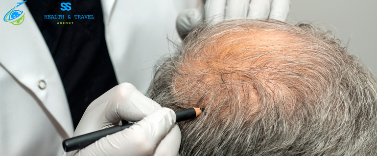 Hair Transplant